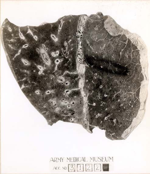 Picture of Lung: Reeve 42859- Lung. Influenza, Bronchopneumonia. Inter-lobar pleurisy. Credit: National Museum Of Health And Medicine.